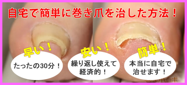 自宅で簡単に巻き爪を治す方法