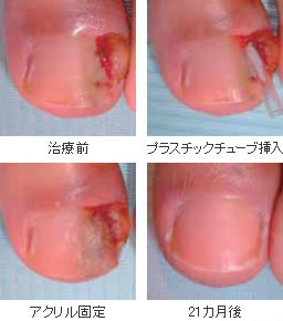 アクリル固定ガター法の治療画像