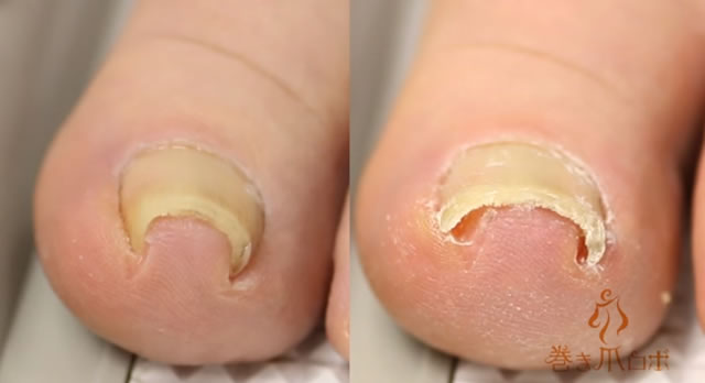 巻き爪ビフォーアフター