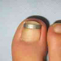 巻き爪治療の金属プレートを使ったプレート法