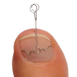 VHO式巻き爪治療法について