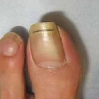 マチワイヤー法の巻き爪矯正画像